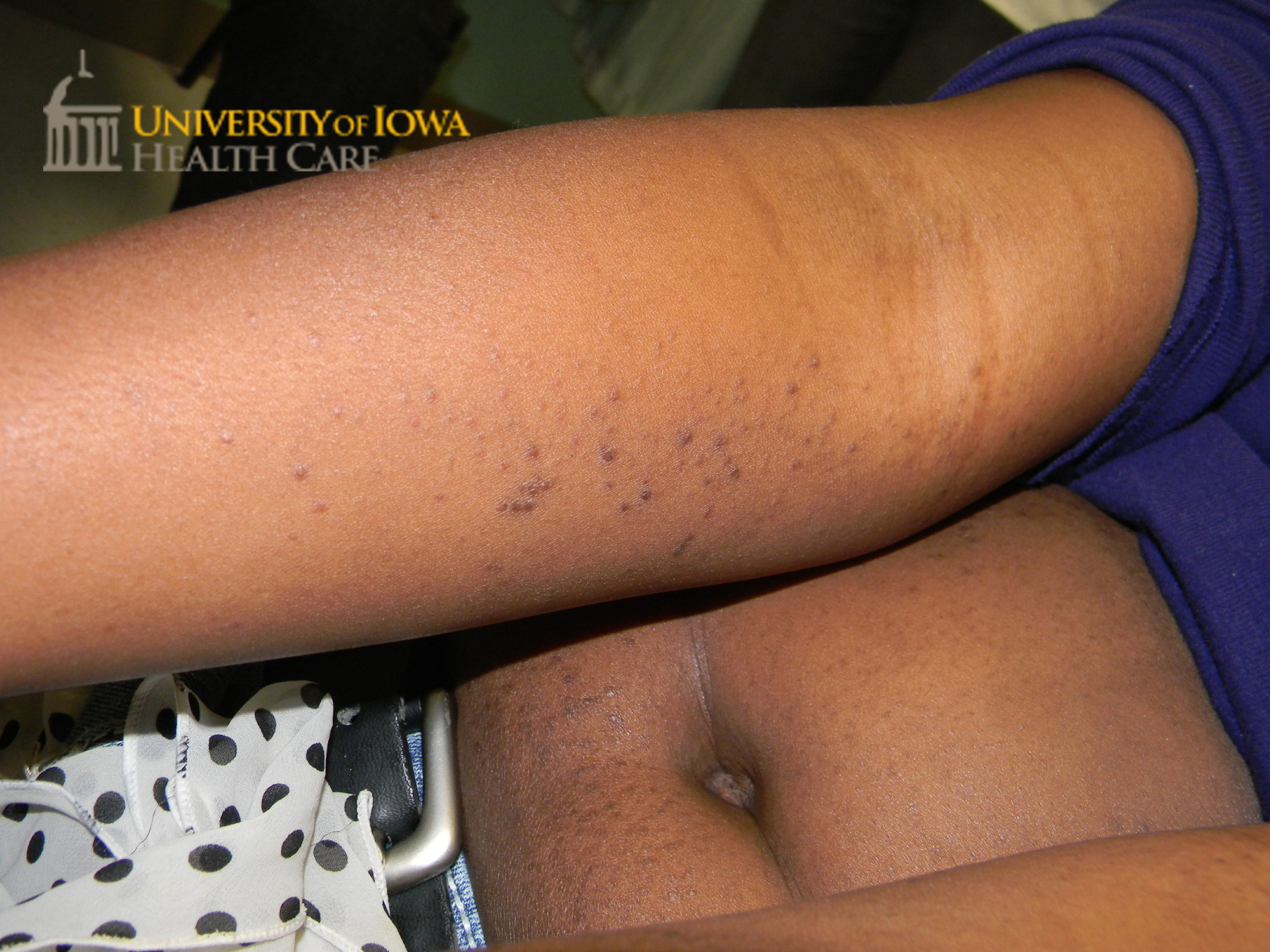 Hyperpigmented monomorphic papules on the trunk and arms. (click images for higher resolution).